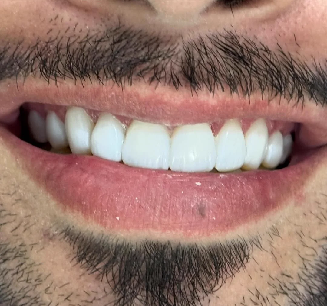 Resultado estético após o procedimento odontológico